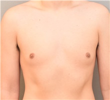 Male Breast Reduction Before Photo by Keshav Magge, MD; Bethesda, MD - Case 38642