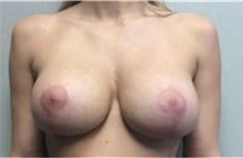 Breast Implant Removal After Photo by Mariam Awada, MD, FACS; ,  - Case 38839