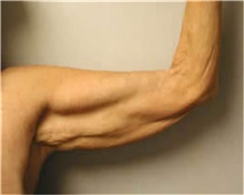 Arm Lift Before Photo by Mariam Awada, MD, FACS; ,  - Case 38868