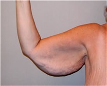 Arm Lift Before Photo by Mariam Awada, MD, FACS; ,  - Case 38870