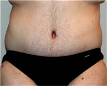 Body Lift After Photo by Mariam Awada, MD, FACS; ,  - Case 38876