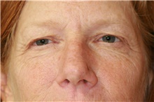 Eyelid Surgery Before Photo by Steve Laverson, MD, FACS; Rancho Santa Fe, CA - Case 39093