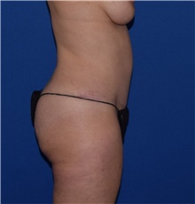 Tummy Tuck After Photo by Karol Gutowski, MD, FACS; Glenview, IL - Case 39132