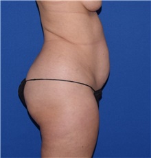 Tummy Tuck Before Photo by Karol Gutowski, MD, FACS; Glenview, IL - Case 39132
