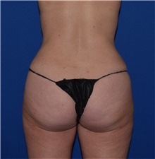 Tummy Tuck After Photo by Karol Gutowski, MD, FACS; Glenview, IL - Case 39132