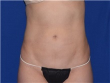 Liposuction After Photo by Karol Gutowski, MD, FACS; Glenview, IL - Case 39163