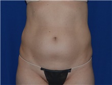 Liposuction Before Photo by Karol Gutowski, MD, FACS; Glenview, IL - Case 39163