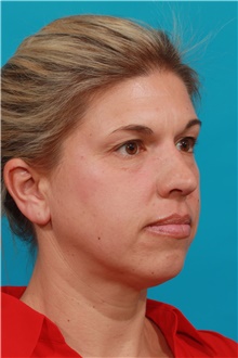 Eyelid Surgery Before Photo by Michael Bogdan, MD, MBA, FACS; Grapevine, TX - Case 39206