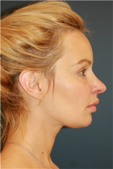 Rhinoplasty Before Photo by Steve Laverson, MD, FACS; Rancho Santa Fe, CA - Case 39346