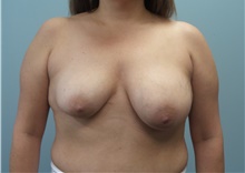 Breast Reconstruction Before Photo by C. Andrew Salzberg, MD; Vero Beach, FL - Case 39379