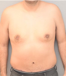 Male Breast Reduction After Photo by Keshav Magge, MD; Bethesda, MD - Case 39543