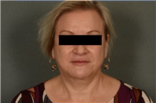 Liposuction After Photo by Ellen Janetzke, MD; ,  - Case 39555