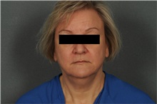 Liposuction Before Photo by Ellen Janetzke, MD; ,  - Case 39555