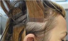 Hair Transplant Before Photo by Ellen Mahony, MD; Westport, CT - Case 39652
