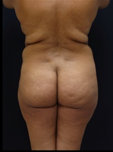 Buttock Lift with Augmentation Before Photo by Johnny Franco, MD; ,  - Case 39927