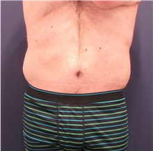 Body Lift After Photo by Michele Shermak, MD; ,  - Case 39971