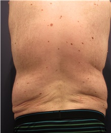 Body Lift Before Photo by Michele Shermak, MD; ,  - Case 39971