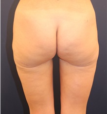 Thigh Lift After Photo by Michele Shermak, MD; ,  - Case 39975