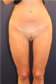 Thigh Lift After Photo by Michele Shermak, MD; ,  - Case 39975