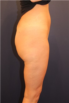 Thigh Lift After Photo by Michele Shermak, MD; ,  - Case 39975