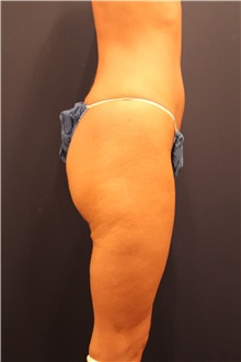 Thigh Lift Before Photo by Michele Shermak, MD; ,  - Case 39975