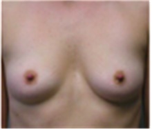 Breast Augmentation Before Photo by Mariam Awada, MD, FACS; ,  - Case 40136