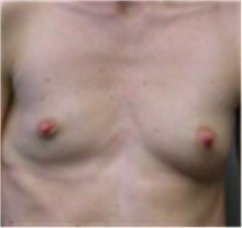 Breast Augmentation Before Photo by Mariam Awada, MD, FACS; ,  - Case 40142