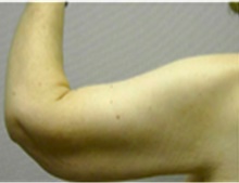 Arm Lift After Photo by Mariam Awada, MD, FACS; ,  - Case 40201