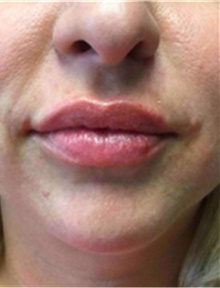 Dermal Fillers After Photo by Mariam Awada, MD, FACS; ,  - Case 40256
