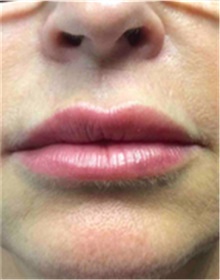 Dermal Fillers After Photo by Mariam Awada, MD, FACS; ,  - Case 40258