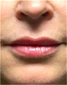 Dermal Fillers Before Photo by Mariam Awada, MD, FACS; ,  - Case 40258