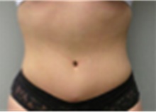 Mommy Makeover After Photo by Mariam Awada, MD, FACS; ,  - Case 40276