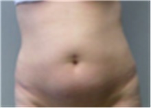 Mommy Makeover Before Photo by Mariam Awada, MD, FACS; ,  - Case 40276