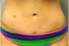 Tummy Tuck After Photo by Mariam Awada, MD, FACS; ,  - Case 40324