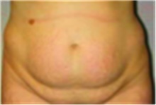 Tummy Tuck Before Photo by Mariam Awada, MD, FACS; ,  - Case 40324