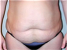 Tummy Tuck Before Photo by Mariam Awada, MD, FACS; ,  - Case 40330
