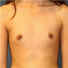 Breast Augmentation Before Photo by Steve Laverson, MD, FACS; Rancho Santa Fe, CA - Case 40637
