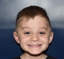 Craniosynostosis After Photo by Rachel Ruotolo, MD; Garden City, NY - Case 40731