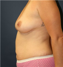 Mommy Makeover Before Photo by Steve Laverson, MD, FACS; Rancho Santa Fe, CA - Case 40830