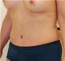 Tummy Tuck After Photo by Steve Laverson, MD, FACS; Rancho Santa Fe, CA - Case 40831