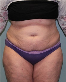 Liposuction Before Photo by Jennifer Greer, MD; Mentor, OH - Case 41018