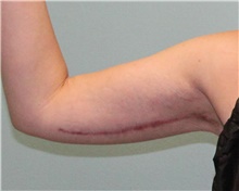 Arm Lift After Photo by Jennifer Greer, MD; Mentor, OH - Case 41042