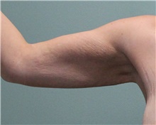 Arm Lift Before Photo by Jennifer Greer, MD; Mentor, OH - Case 41042