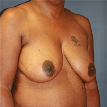 Breast Lift Before Photo by Steve Laverson, MD, FACS; Rancho Santa Fe, CA - Case 41070