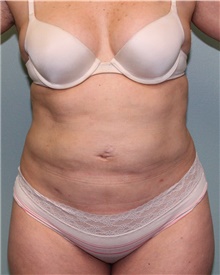 Liposuction After Photo by Jennifer Greer, MD; Mentor, OH - Case 41102
