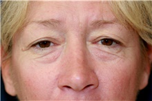 Eyelid Surgery Before Photo by Steve Laverson, MD, FACS; Rancho Santa Fe, CA - Case 41210