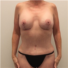Mommy Makeover After Photo by Ravi Somayazula, DO; Houston, TX - Case 41260