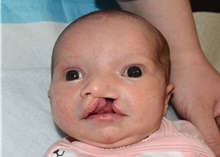 Cleft Lip and Palate Repair Before Photo by Rachel Ruotolo, MD; Garden City, NY - Case 41348