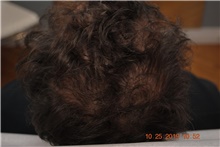 Hair Transplant After Photo by Ellen Mahony, MD; Westport, CT - Case 41441