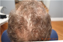 Hair Transplant Before Photo by Ellen Mahony, MD; Westport, CT - Case 41441